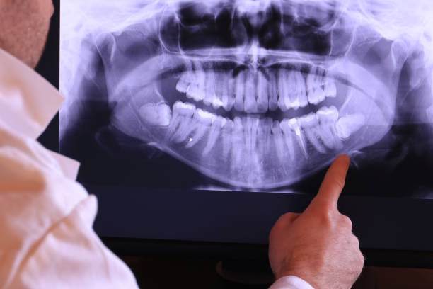 Best Knocked-Out Tooth (Avulsed Tooth) Treatment in Lexington Hills, CA